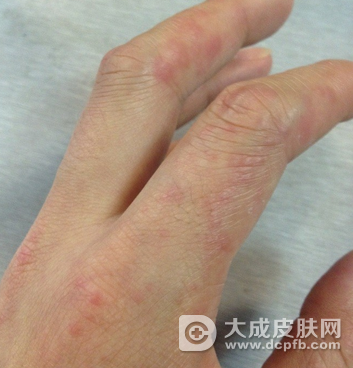 专家提醒治疗银屑病要规范 勿乱用激素
