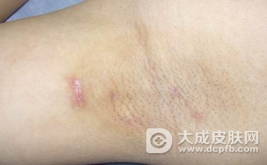 狐臭有哪些症状 狐臭常见的治疗方法