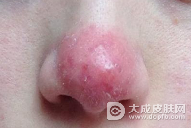 冬至已至 当心寒冷诱发酒糟鼻