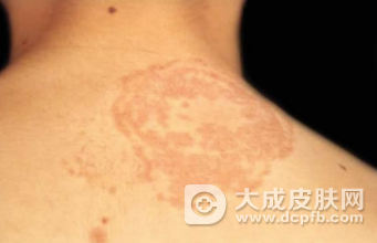 金钱癣有什么症状 金钱癣的基本特征