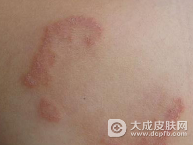 治疗体癣用什么药膏 体癣要注意什么