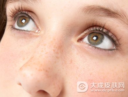 脸上的黄褐斑怎么去掉 最好用的祛斑方法