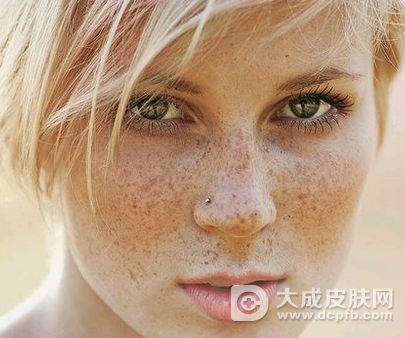 脸上有雀斑怎么办 去雀斑最有效的方法