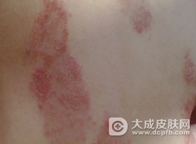 银屑病在冬季易复发加重 要进行正规治疗