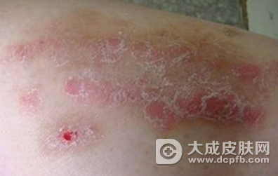 中医治疗银屑病的原理是什么 为什么选择中医