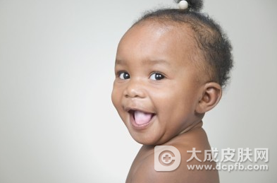 婴儿得了白癜风能治疗吗 婴儿白癜风怎么办