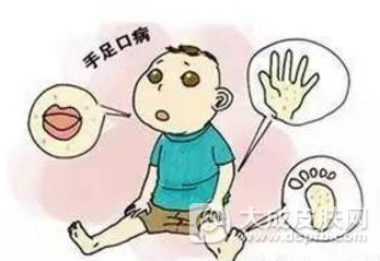 手足口病传染性较强 对待手足口病马虎不得