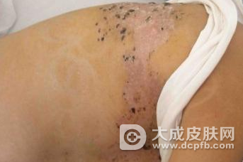 秋冬带状疱疹高发 及时治疗是关键