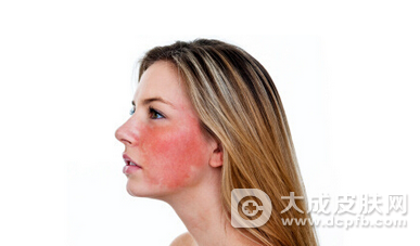 冬季敏感肌肤面部红血丝如何保养