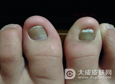 灰指甲的发病原因是什么 如何避免灰指甲传染呢