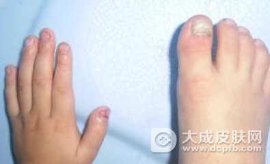 冬季灰指甲怎么治 灰指甲注意事项