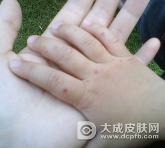 湖南省手足口病疫情出现了秋冬季流行小高峰