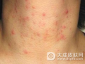 得了湿疹皮炎怎么办 湿疹性皮炎的治疗方法