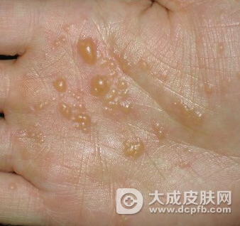 湿疹的发病原因是什么 水疱性湿疹怎么治疗