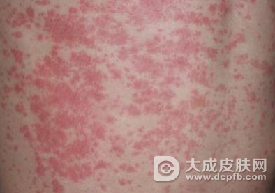 湿疹是由真菌引起的吗 真菌性湿疹的致病菌有哪些