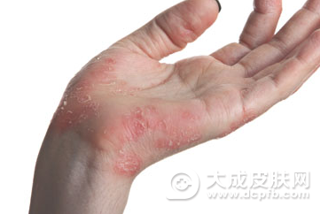 患了过敏性皮炎湿疹怎么办 日常注意防护
