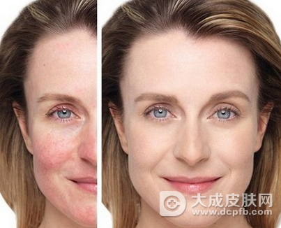 面部皮肤过敏怎么办 怎么预防皮肤过敏