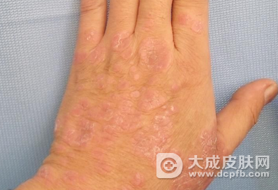 银屑病与癣类疾病怎么区分 银屑病怎么治疗