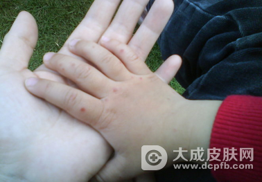 儿童感染疾病中手足口病最常见 怎样治疗手足口病