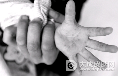 上海市手足口病疫情大幅度上升 推荐婴幼儿接种EV71疫苗