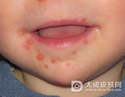 儿童发水痘别用激素软膏涂抹 预防水痘注意五方面