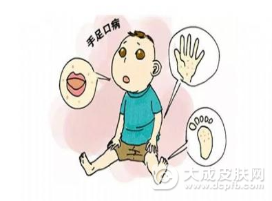 预防儿童手足口病要养成良好的卫生习惯