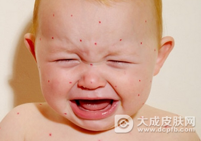 小儿湿疹的病因是什么 小儿湿疹日常如何护理