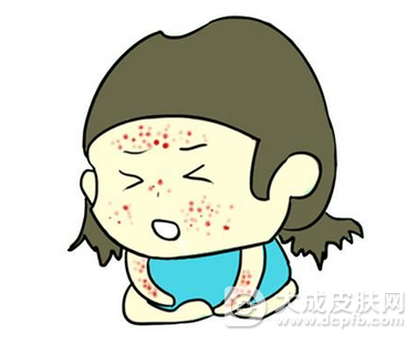 湿疹预防需按年龄而定 日常如何预防湿疹