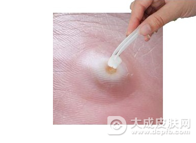 脚上长鸡眼怎么办 鸡眼的症状和治疗