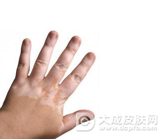 怎么预防儿童白癜风 白癜风对孩子的危害