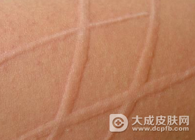 冬季易患皮肤病 五招应对风疹荨麻疹