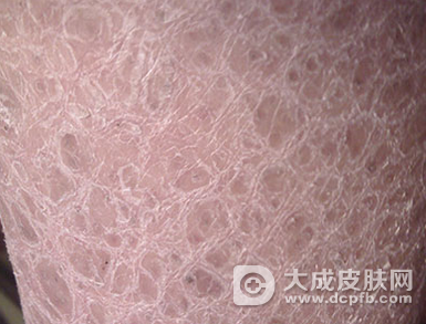 鱼鳞皮肤病会传染吗 注意日常生活护理