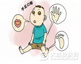 小儿手足口病的传播途径有哪些 手足口病如何预防