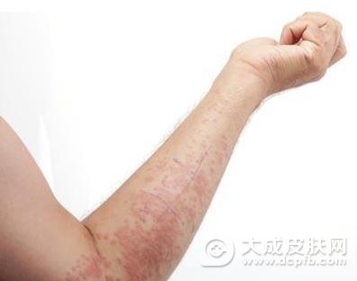 湿疹反复发作教您轻松应对