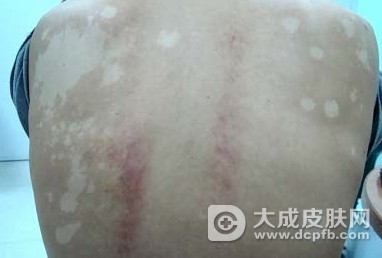 夏季治疗汗斑的中医方法