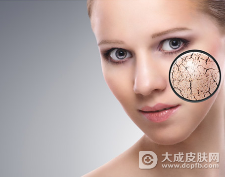 皮肤干燥