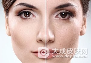 皮肤粗糙