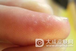 手上长水泡奇痒难忍是怎么回事