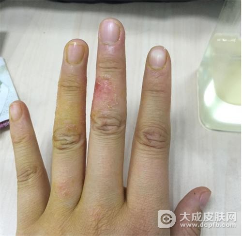 常见的湿疹症状 教你认识湿疹