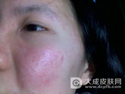 改善皮肤过敏的方