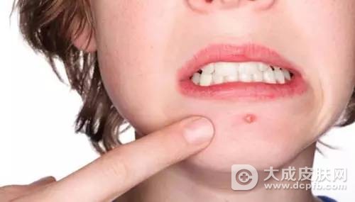 生理期长痘太困扰 教你中药方祛痘