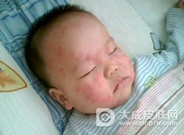 孩子游泳回来 全身竟长丘疹
