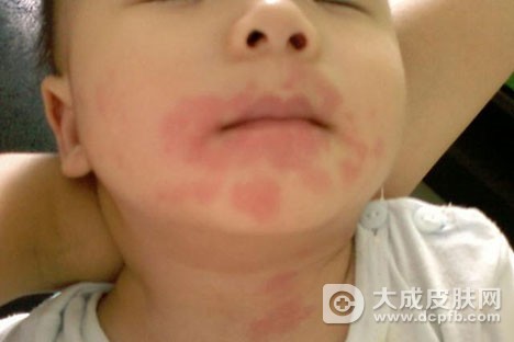小儿荨麻疹有哪些症状表现