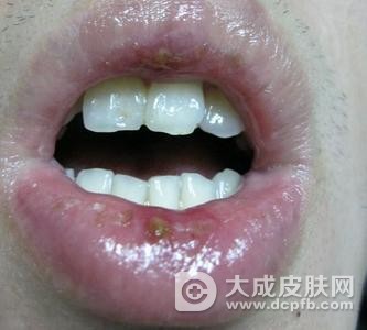 患上白塞病的原因有哪些