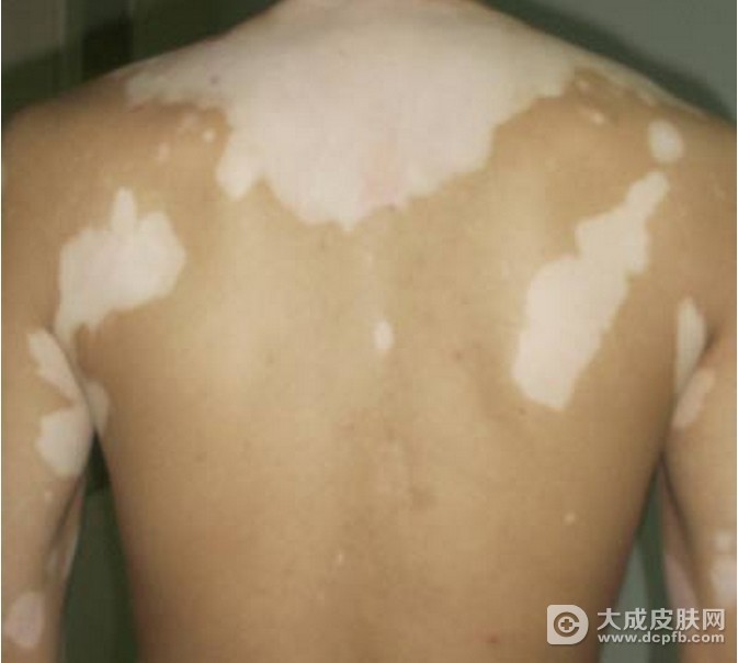 秋季治疗白癜风,事半功倍