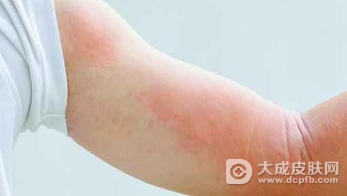 牛仔裤竟能引发荨麻疹