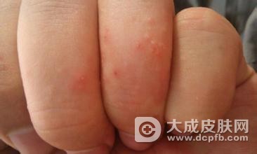 手上痒痒长水泡是哪些病