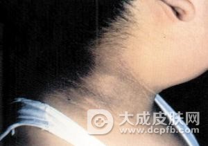 脖子发黑洗不净 小心是肥胖引起黑棘皮病