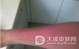 改善日光性皮炎,在饮食上需注意