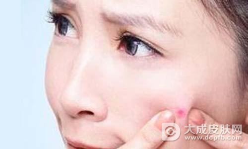 长痘痘可以挤压吗,该怎么护理